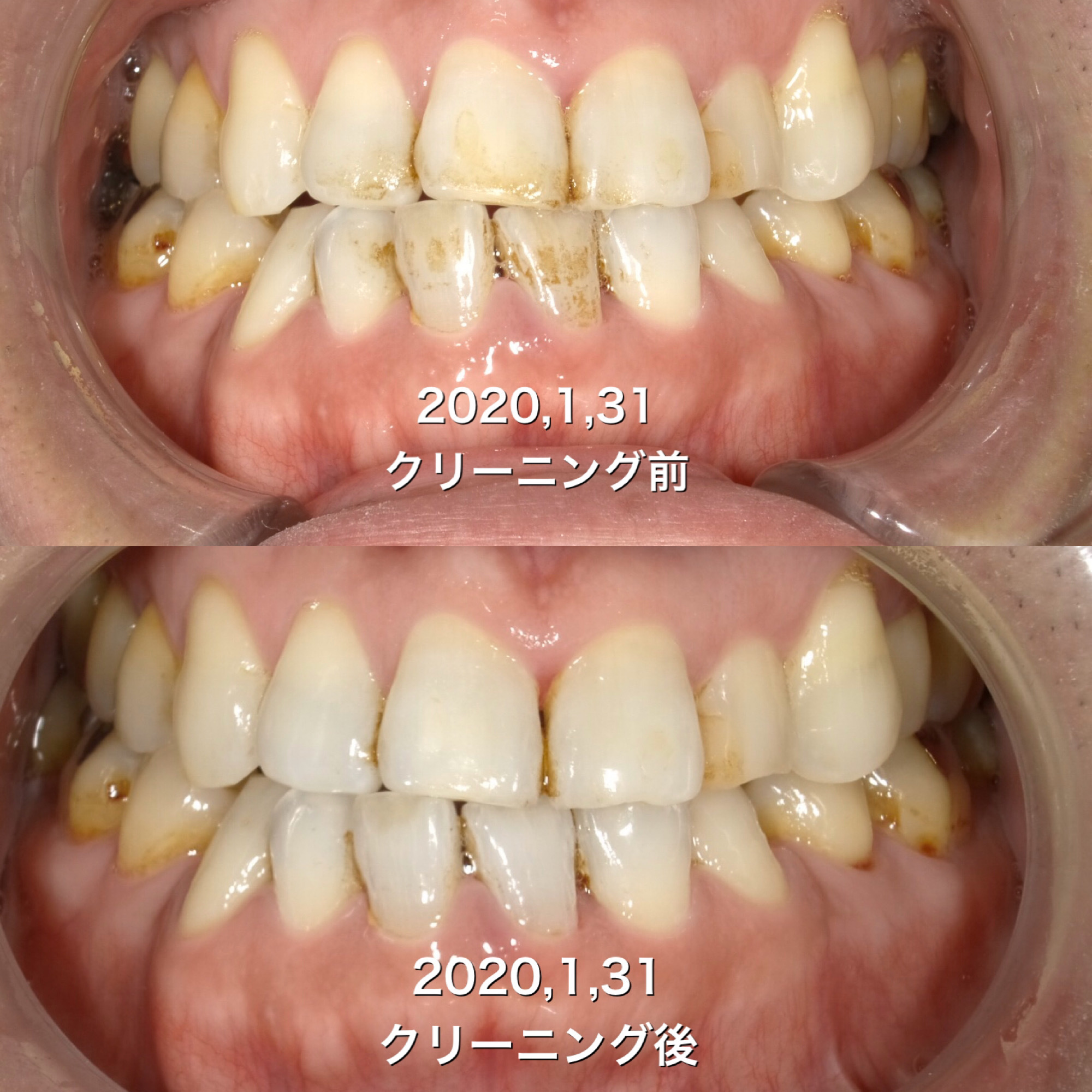 子供 歯茎 腫れ 腫れ 子供 歯茎